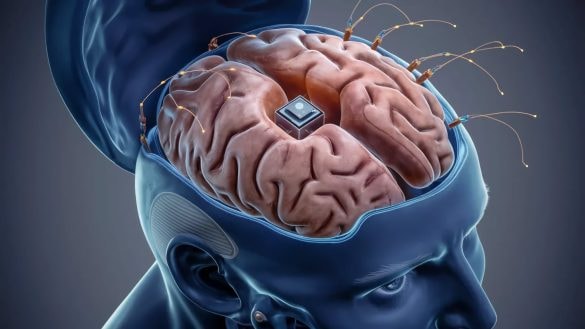 Neuralink chystá nový čip do mozku. První generace překonala všechna očekávání